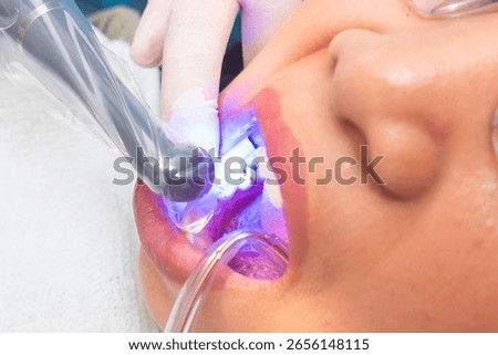 Final polymerization phase of dental composite using curing light on a lower premolar to harden the restoration material securely.