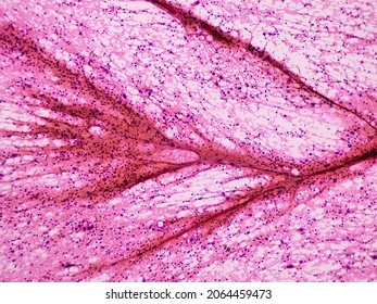 Fine Needle Aspirate Cytology Metastatic Melanoma Stock Photo ...