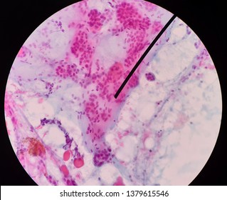 Fine Needle Aspiration (FNA) Cytology Of Nodular Goiter Of Thyroid, With Follicular Cell, Colloid Material And Few Hemosiderin Laden Macrophages.