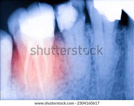 Fine-tuned teeth x-ray result from monitor presenting healthy root and ruin gum from pyorrhea and gumboil by patient aged and wrong usage and brushing