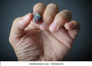 Bruised Nail Images Stock Photos Vectors Shutterstock