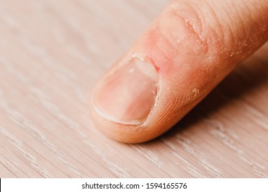 Finger Condition Before Manicure - Crooked Dirty Nails