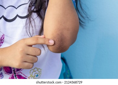 Finger of girl point to her elbow because dark patches on the skin and allergic rash known as acanthosis nigricans look like a darkened velvet. - Shutterstock ID 2124368729