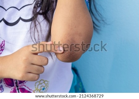 Finger of girl point to her elbow because dark patches on the skin and allergic rash known as acanthosis nigricans look like a darkened velvet.