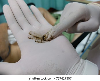 Finger With Gloves Showing Black Color Faeces Or Malena Indicates Patient With Upper Gastrointestinal Bleeding. Blurry Background Due To Bokeh Effect.