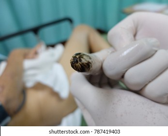 Finger With Gloves Showing Black Color Faeces Or Malena Indicates Patient With Upper Gastrointestinal Bleeding. Blurry Background Due To Bokeh Effect.