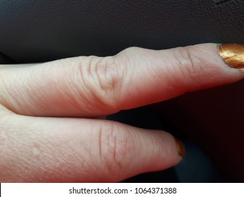 Finger Lipoma (hand)