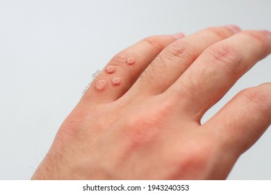 Finger With Lots Of Warts. Viral Warts On Hand.