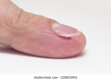 Finger with severed nail and burr, blood, macro, white background, cuticle, copy space, barb - Shutterstock ID 1258510951