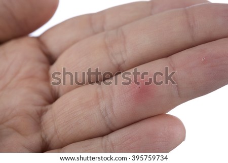 Finger with splinter isolated on white background.
