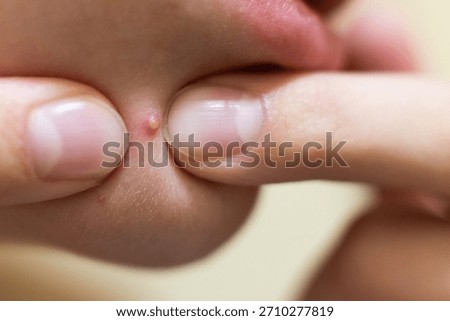 Fingers applying pressure to skin developing an acne breakout whitehead. Teenage person having pimple and pustule. Skin care and problems concept.
