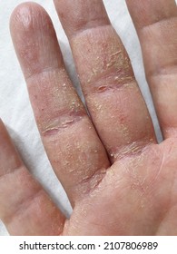 The fingers of the hand covered with psoriasis