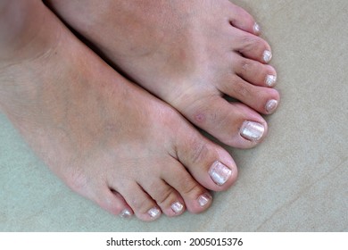 Fingers On The Woman's Leg. Ingrown Toenails On A Woman's Foot Pain In The Big Toe Closeup