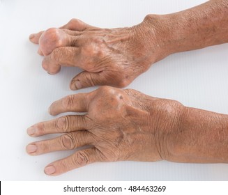 Fingers of patient with gout.
