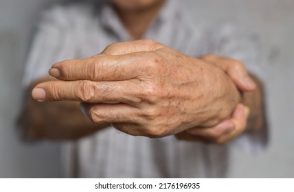 Fingers Rigidity, Hand Muscles Spasm, Or Weakness Of Digits. Closeup View.