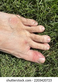 Fire Ant Bites On A Foot