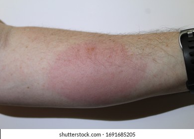 Fire Ant Sting On Arm With Large Local Reaction On Skin.