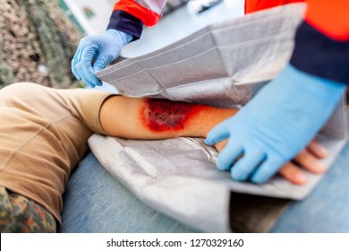 First Aid Bandage On Burnt Wound Victim