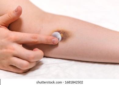 picadura de insecto hematoma picadura de insecto hematoma