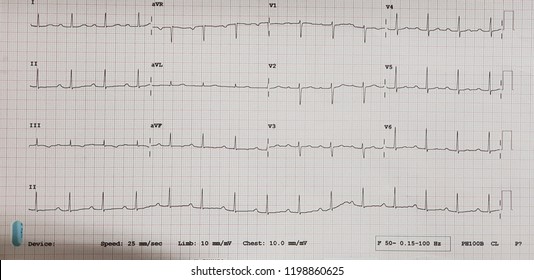 First Degree Av Block. Normal Sinus Rhythm.