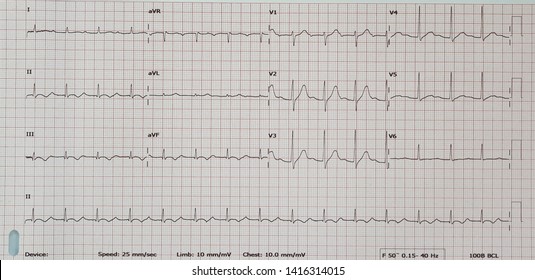 First Degree AV Block. Sinus Rhythm.