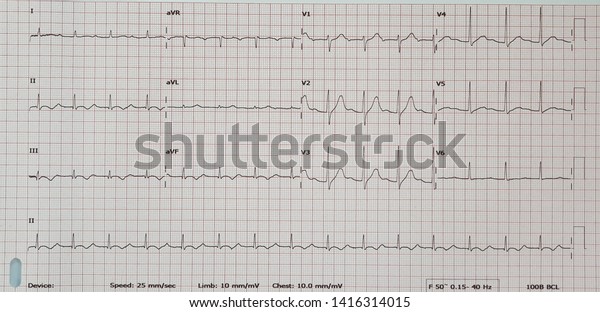 First Degree Av Block Sinus Rhythm Stock Photo Edit Now