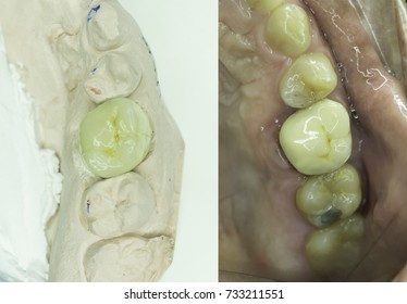 First Molar Porcelain Fused Metal Crown Stock Photo 733211551 ...