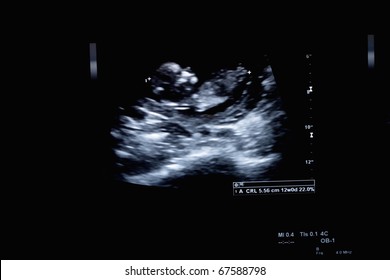 first trimester ultrasound baby xray of Fraternal twin