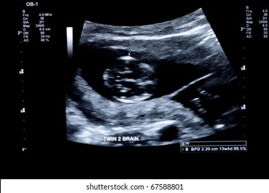 first trimester ultrasound baby xray of Fraternal twin