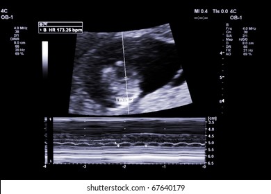first trimester ultrasound baby xray of Fraternal twin heartbeat