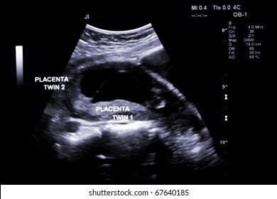 first trimester ultrasound baby xray of Fraternal twin placenta