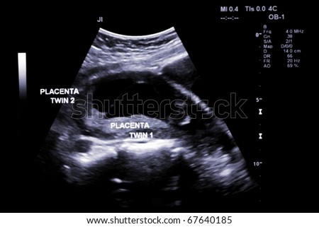 first trimester ultrasound baby xray of Fraternal twin placenta