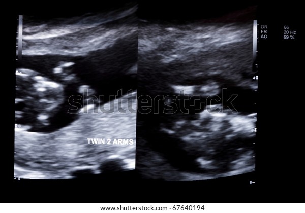 First Trimester Ultrasound Baby Xray Fraternal Stock Photo 67640194 ...