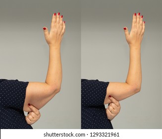 Flabbiness On Woman Arm Before And After Slimming Diet