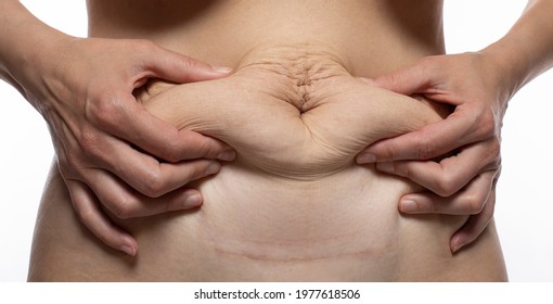 Flabby belly after pregnancy close up, tummy tuck woman waist after gastric bypass