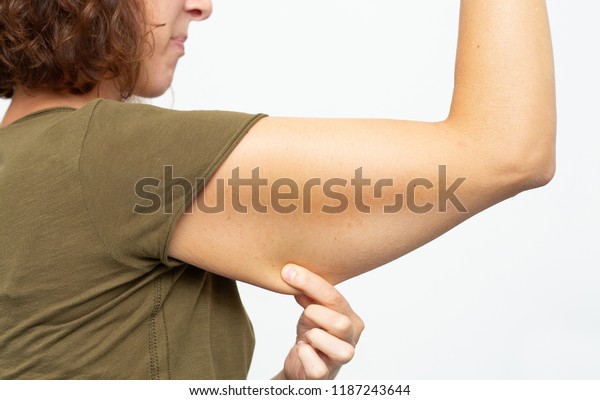 Flabby Skin On Arm After Weight Stock Photo Edit Now