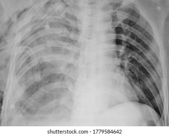 Flail Chest With Multiple Segmental Rib Fractures On Chest Xray.