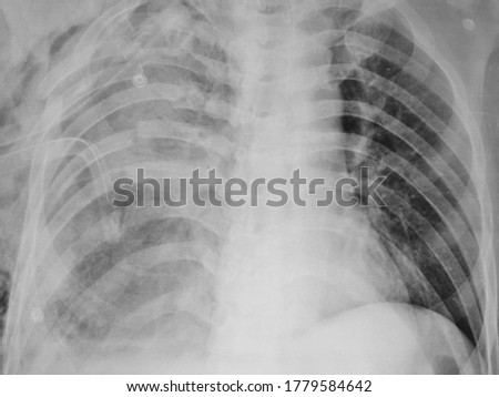 Flail Chest with multiple segmental rib fractures on Chest Xray.