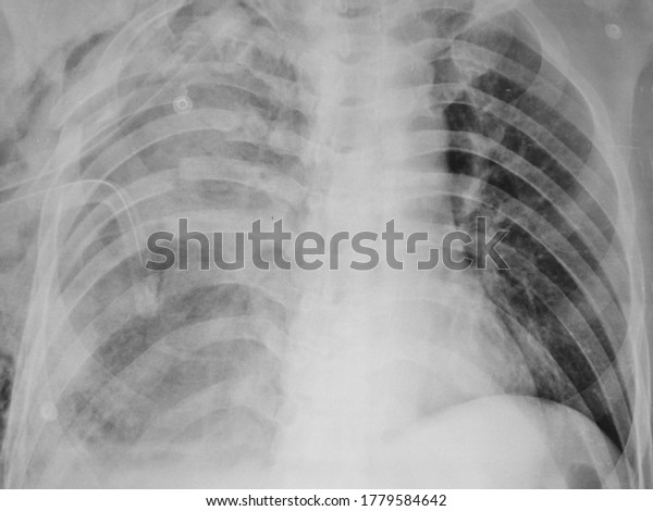 Flail Chest with multiple segmental rib fractures\
on Chest Xray.