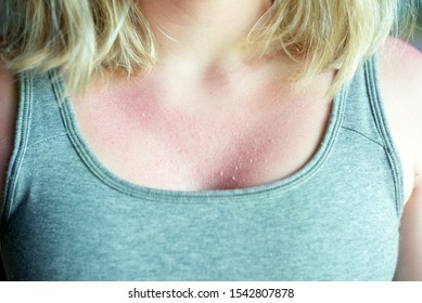 The Flaky Skin From A Bad Tan On The Girl’s Chest Causes Severe Itching. Shallow Depth Of Field