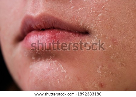 flaky skin of a girl after cosmetic procedures