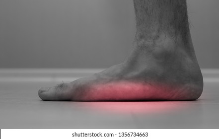 Flat Feet (pes Planus Or Fallen Arches). Close Up Of Flat Men Foot.