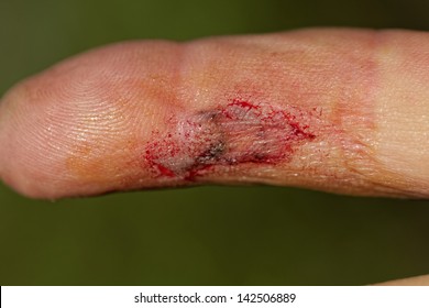 Flesh Wound With Blood On Male Finger