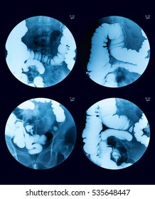 Fluoroscopic Examination Of Lower Gastrointestinal (GI) Tract, A 54 Year Old Woman, Case Of Rectal Caner