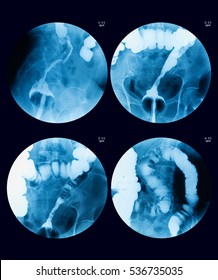 Fluoroscopic Examination Of Lower Gastrointestinal (GI) Tract (Barium Enema Exam, Rectal Cancer