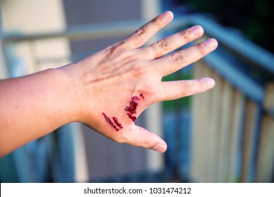 Focus dog bite wound and blood on hand. Infection and Rabies concept. Pet care and rabies prevention concept. Accidental and first aid concept. image for background, objects, copy space.