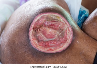 Focus Infected Wound