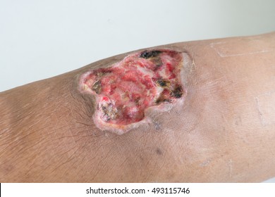Focus Open Wound. Infected Wound