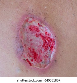 Focus Open Wound. Infected Wound