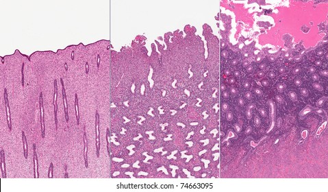 Follicular, Luteal, And Menstrual (left To Right) Stages Of Endometrium In The Menstrual Cycle With Bleeding In The Mestrual Stage (extreme Right)